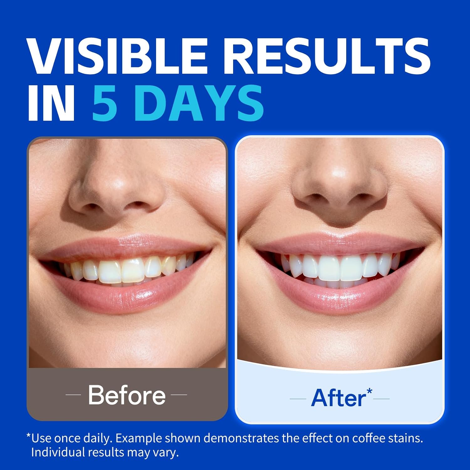 7 pares de tiras blanqueadoras - Teeth Whitening Retainer reseña y precio