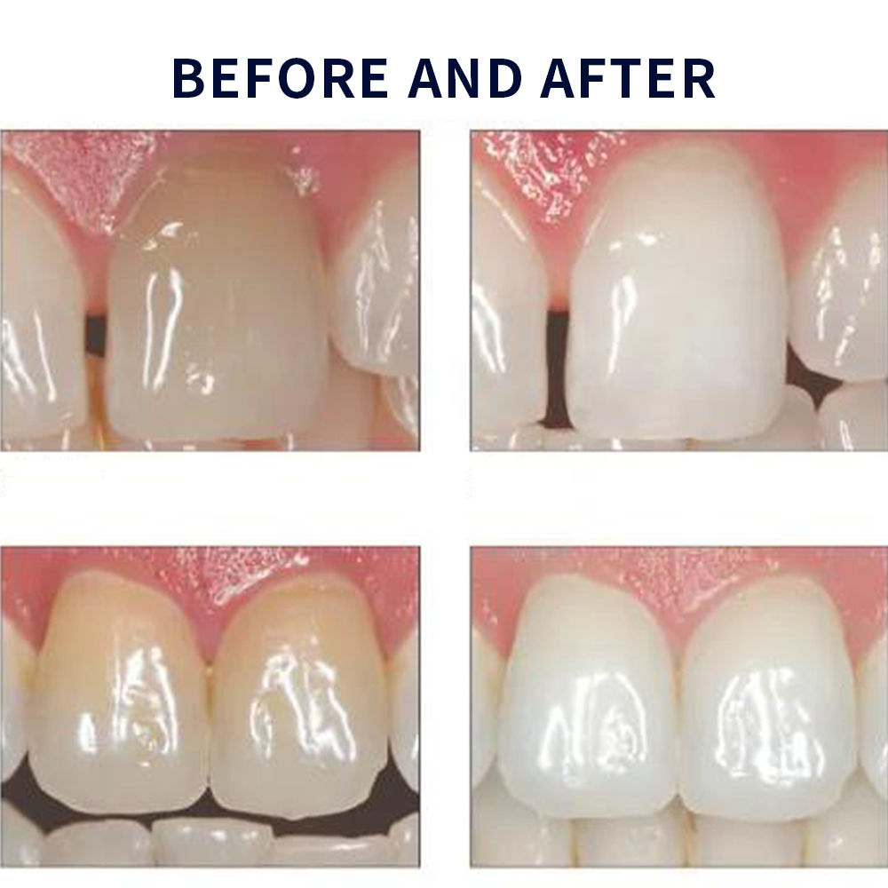 Opalescencia blanqueadora 20%  - Teeth Whitening Bleaching Kit reseña y precio