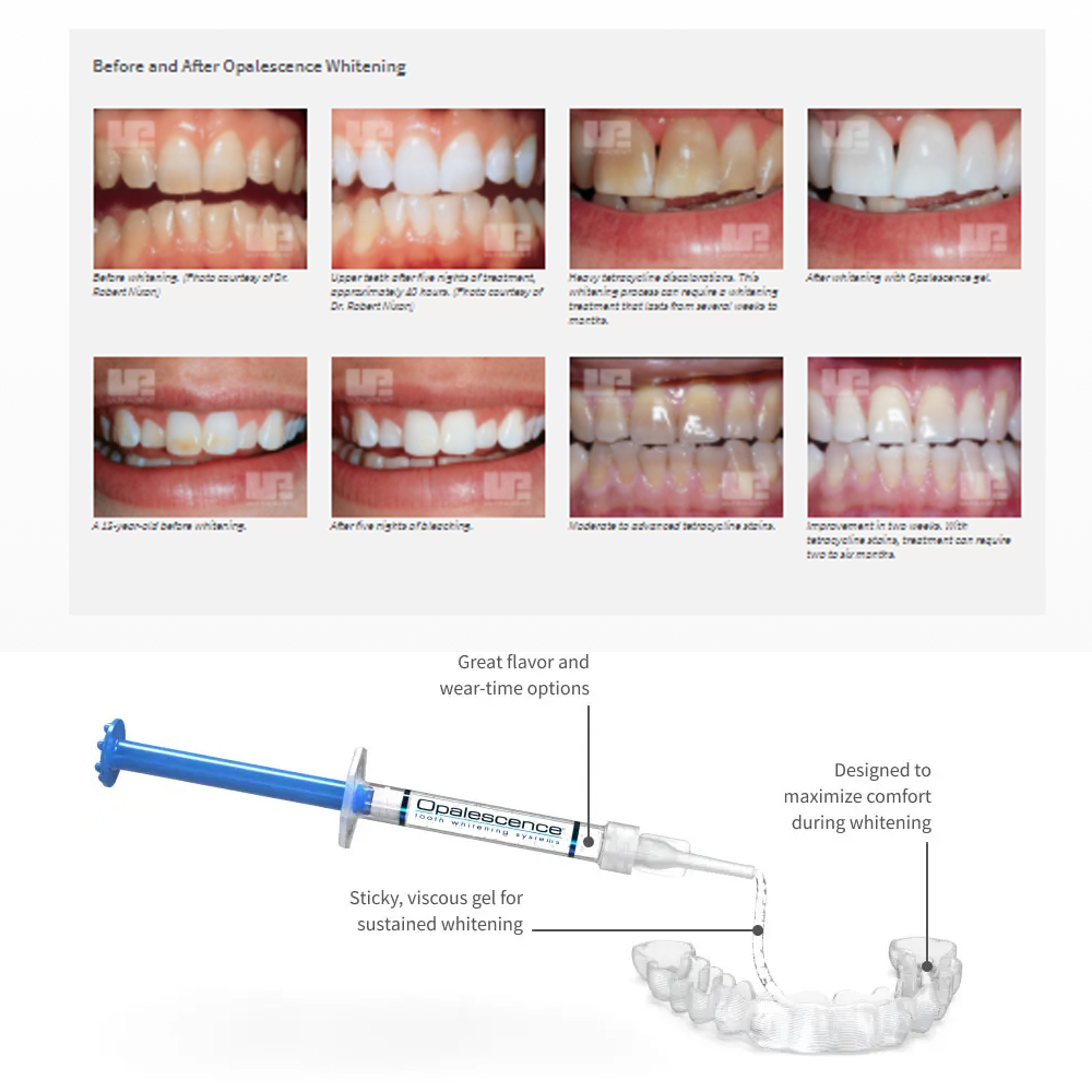 Opalescencia blanqueadora 20%  - Teeth Whitening Bleaching Kit reseña y precio