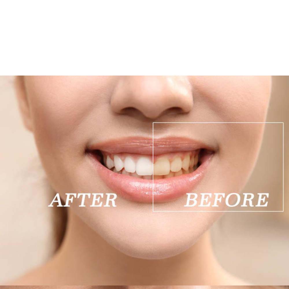 Kit de Gel blanqueador de dien - Teeth Whitening Bleach reseña y precio