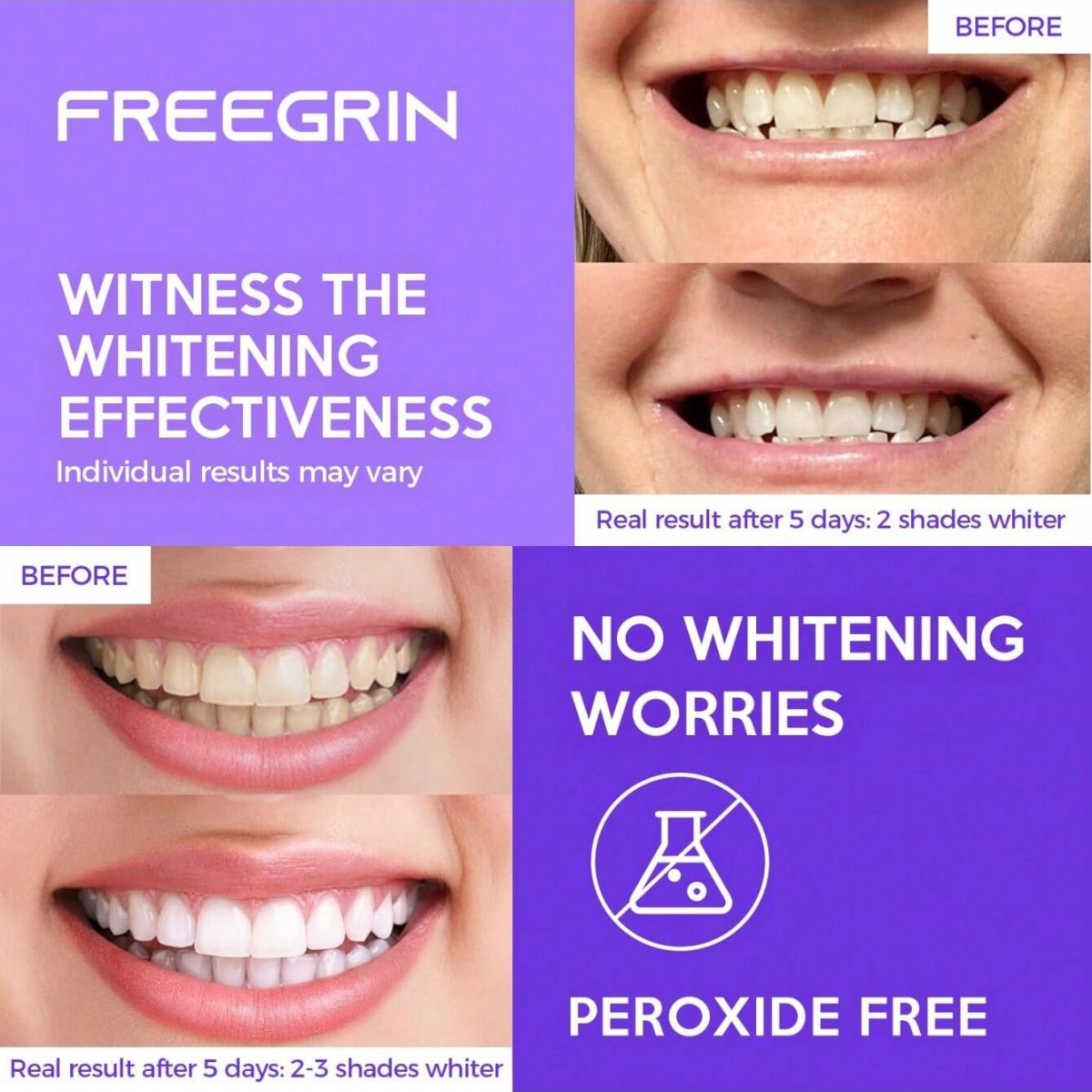 Pegatinas blanqueadoras de die - Teeth Whitening Retainer reseña y precio